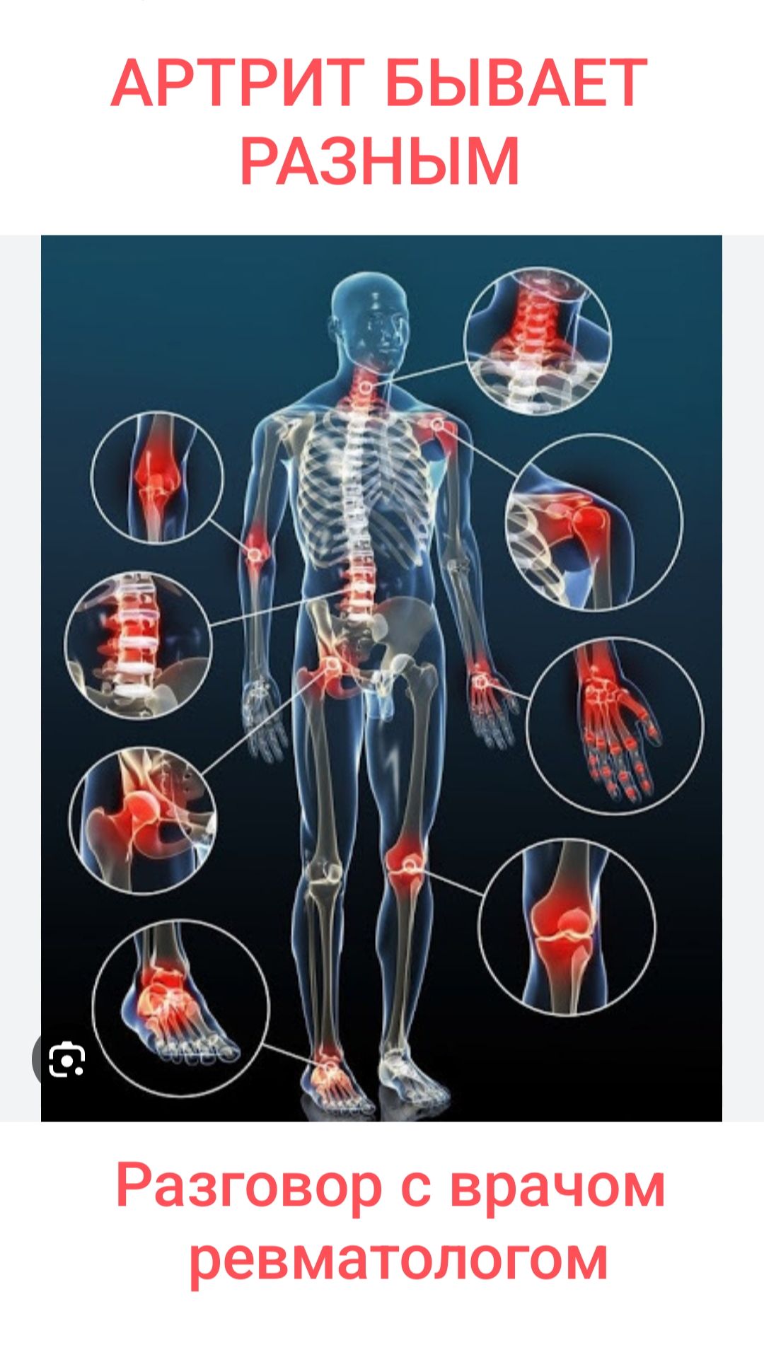 Виды артрита и их лечение. Разговор с ревматологом