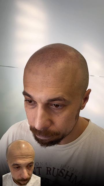 До и после трихопигментации