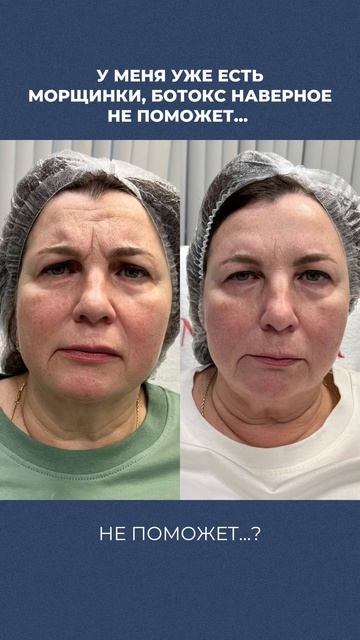 Морщины и Ботокс