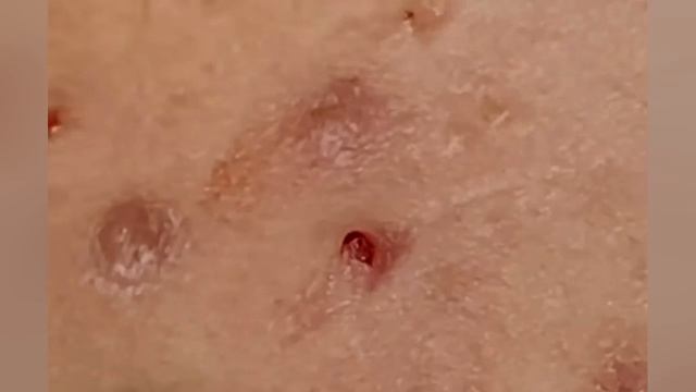 Выдавливание прыщей, угрей, черных точек и камедонов #332