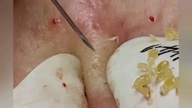 Выдавливание прыщей, угрей, черных точек и камедонов #331