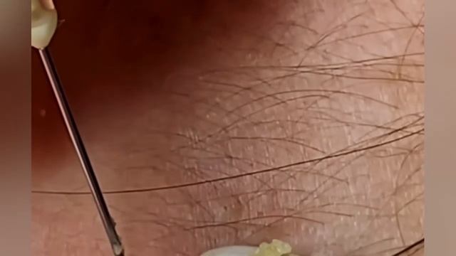 Выдавливание прыщей, угрей, черных точек и камедонов #333