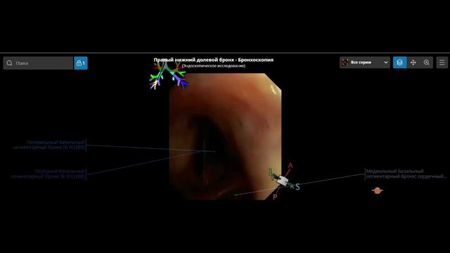 Эндоскопическая анатомия бронхов в норме