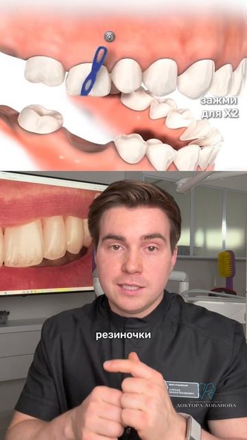 Как улучшится качество жизни после ношения брекетов