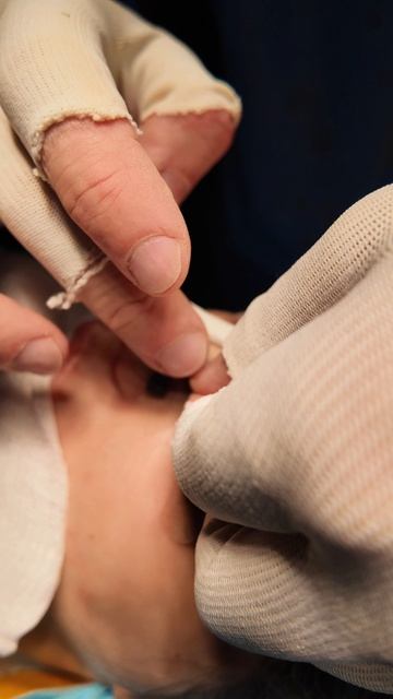 Ринопластика. Результат сразу после операции.