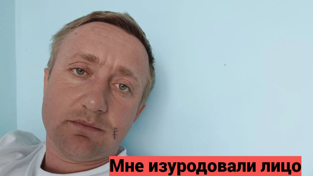 День операции. Почему врач вынужден был порезать мне лицо.