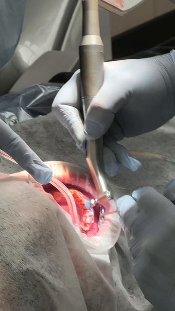 Профессиональная гигиена зубов