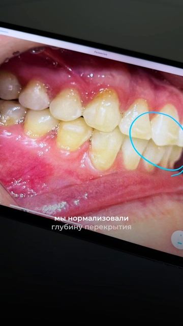 Когда прикус выглядит «почти нормально» 🦷