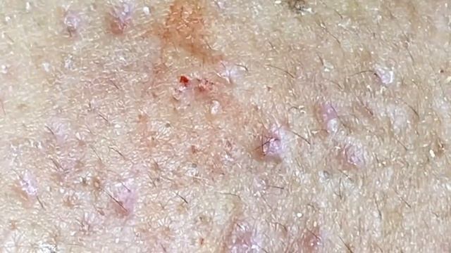 Выдавливание прыщей, угрей, черных точек и камедонов #344