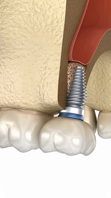 Синус лифтинг — это страшная операция?