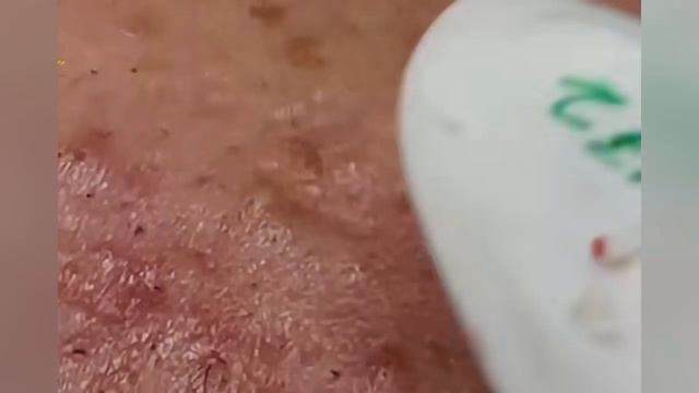 Выдавливание прыщей, угрей, черных точек и камедонов #352