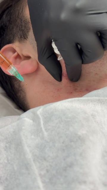 ВЫСЫПАНИЯ В ОБЛАСТИ ЩЕТИНЫ