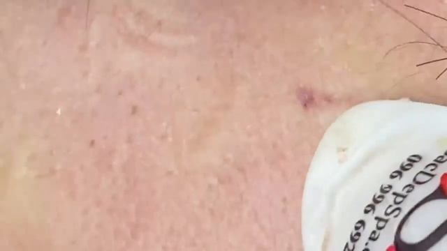 Выдавливание прыщей, угрей, черных точек и камедонов #351