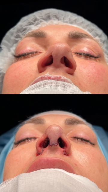 Открытая септоринопластика после травмы