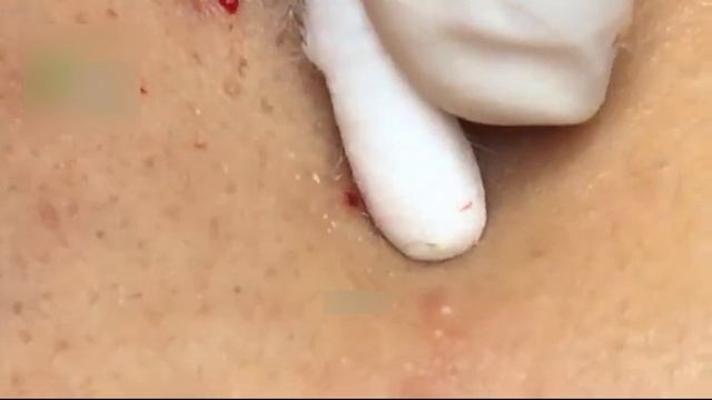 Механическая экстракция: как мы убираем черные точки