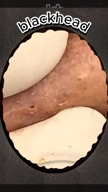 Чистка лица от угрей и акне. Выдавливание прыщей. Удаление черных точек и комедонов