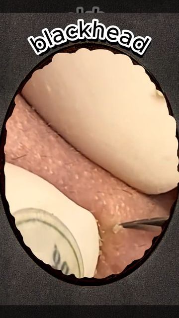 Чистка лица от угрей и акне. Выдавливание прыщей. Удаление черных точек и комедонов