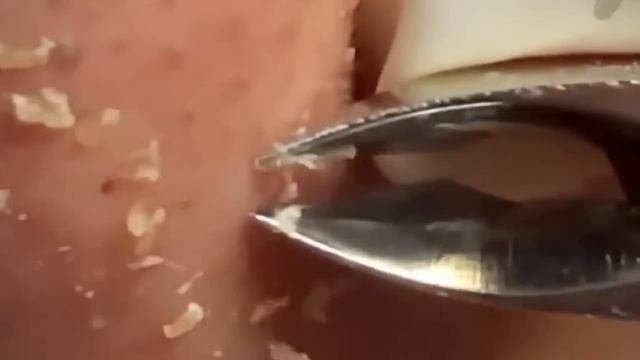 #257 Чистка лица от угрей и акне. Выдавливание прыщей. Удаление черных точек и комедонов