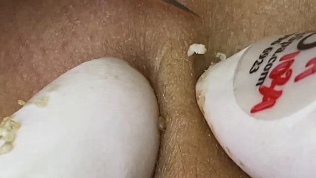 Выдавливание прыщей, угрей, черных точек и камедонов #355