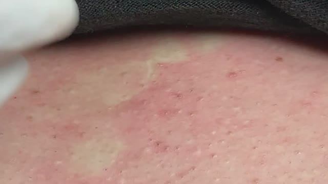 Черные точки по всей груди — лечение акне