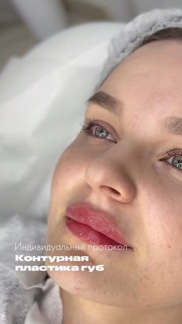 Контурная пластика губ Самые первые губы и результат ✔️