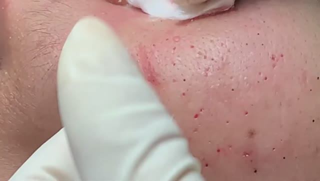 Множество удивительных черных точек. Удаление.