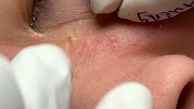 Лечение акне: Секрет идеальной чистки лица