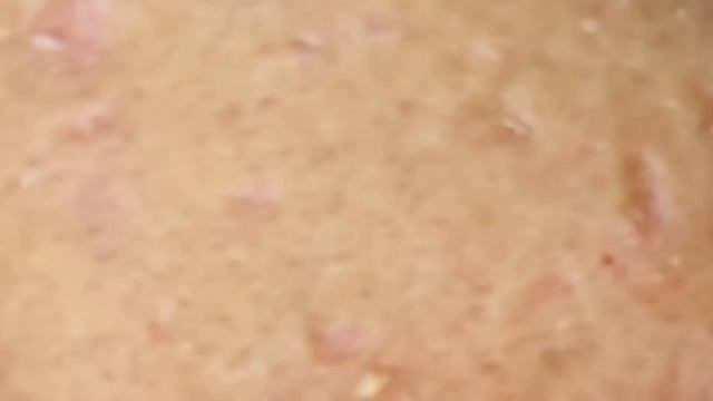 Выдавливание прыщей, угрей, черных точек и камедонов #354