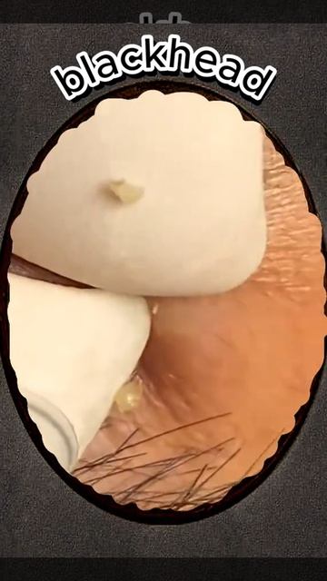 Чистка лица от угрей и акне. Выдавливание прыщей. Удаление черных точек и комедонов