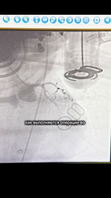 Молодая женщина - инфаркт и операция