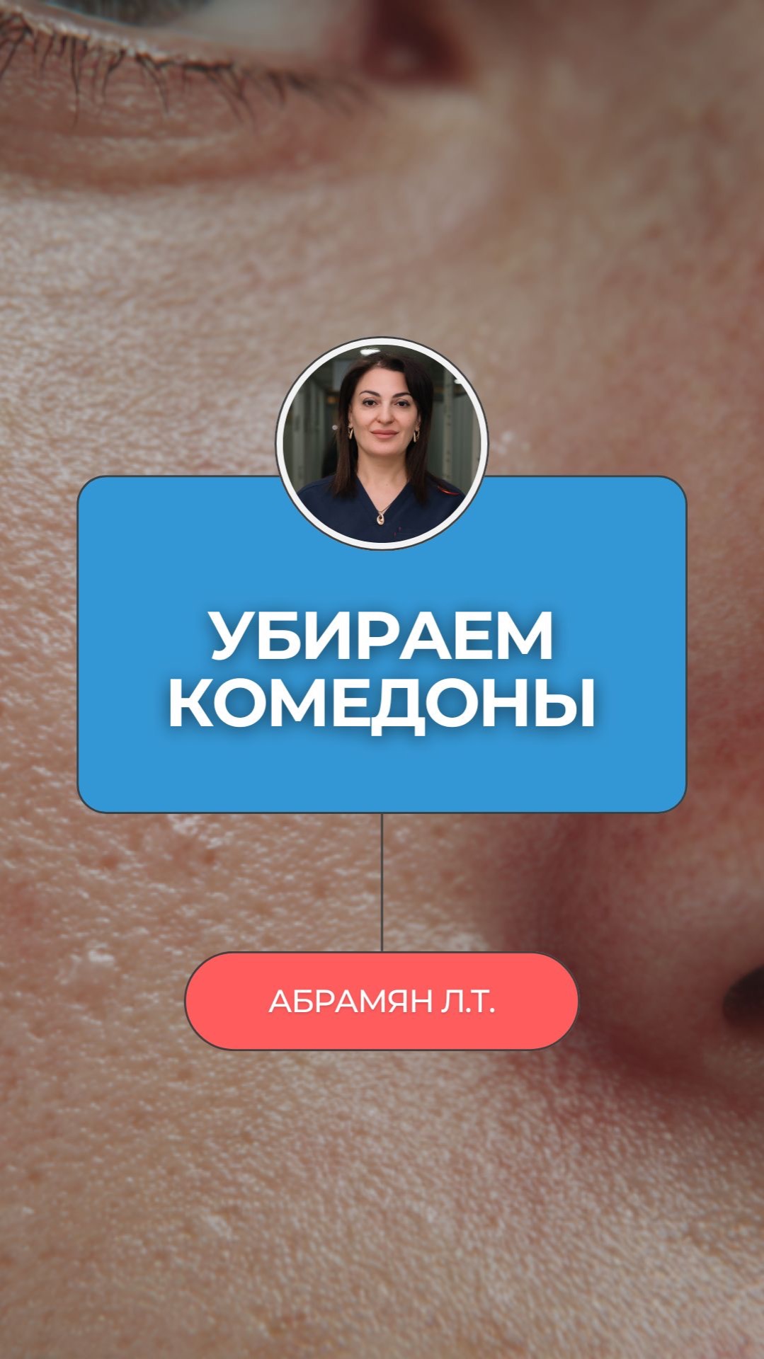 🔍 Закрытые комедоны — три средства из аптеки. Косметолог не расскажет, ей невыгодно. А я расскажу!
