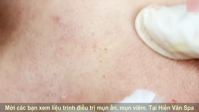 Комплексное очищение: убираем акне всех типов