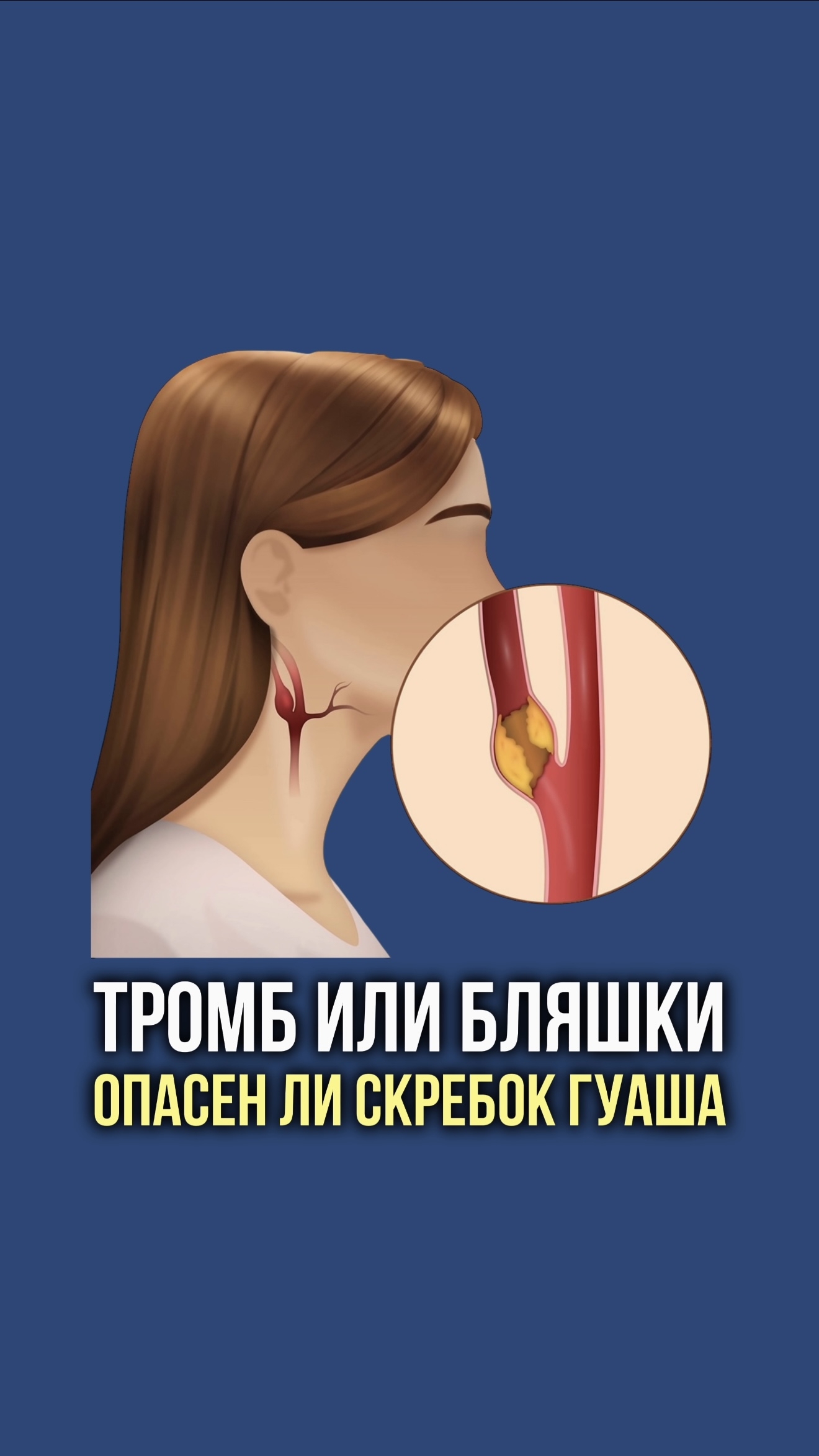 Тромб или бляшки. Опасен ли скребок гуа-ша.