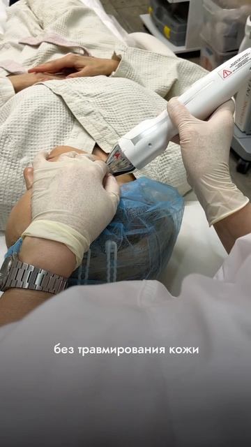 Игольчатый RF - лифтинг на аппарате Вирчу. Без реабилитации и боли!