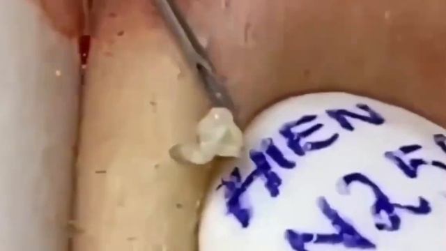 #259 Чистка лица от угрей и акне. Выдавливание прыщей. Удаление черных точек и комедонов