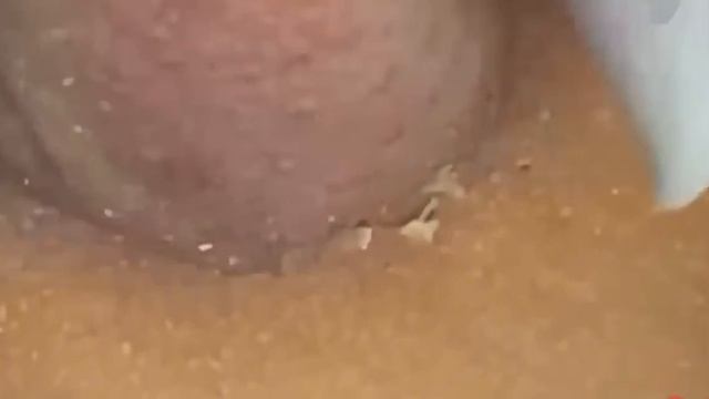 #260 Чистка лица от угрей и акне. Выдавливание прыщей. Удаление черных точек и комедонов