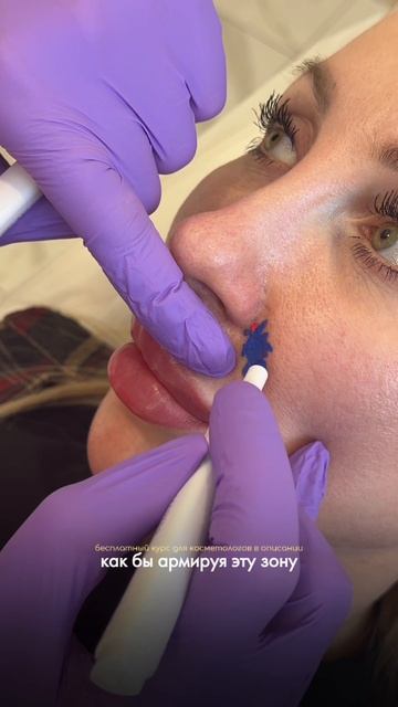 Убираем носогубные складки