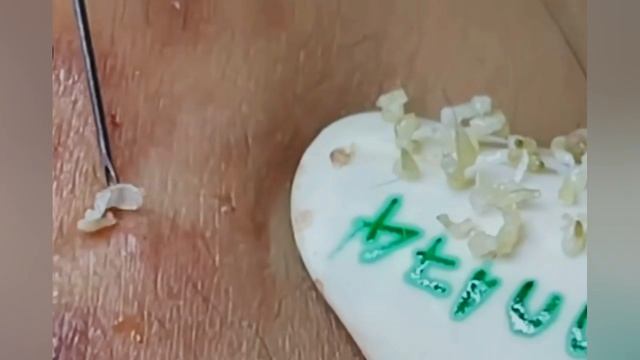 Выдавливание прыщей, угрей, черных точек и камедонов #357