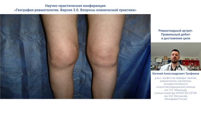 Ревматоидный артрит