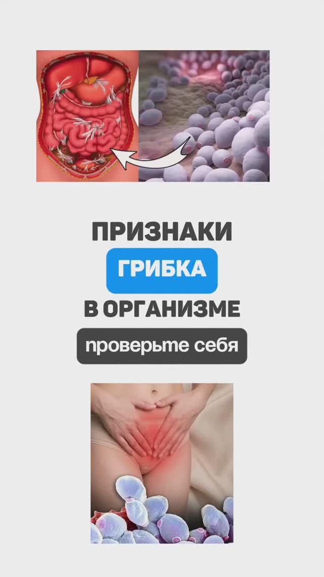 Признаки грибка в организме. Семейный доктор Алена Братишко
