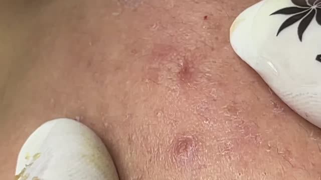 Профессиональная чистка от подкожных угрей