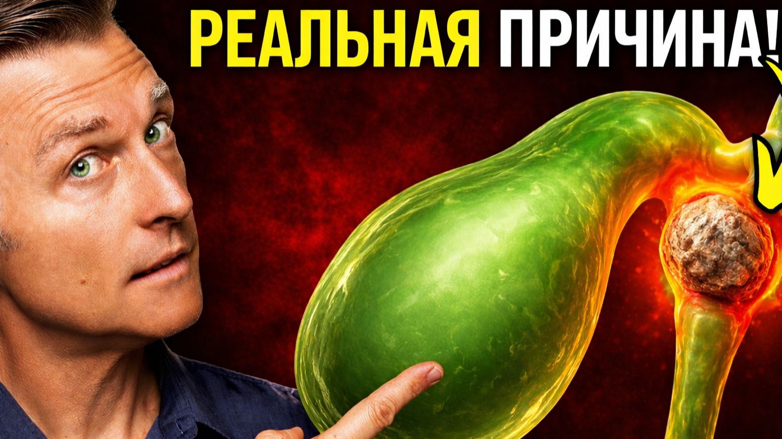 Ошибка с желчекаменной болезнью, которая приводит к ХИРУРГИЧЕСКОМУ ВМЕШАТЕЛЬСТВУ !