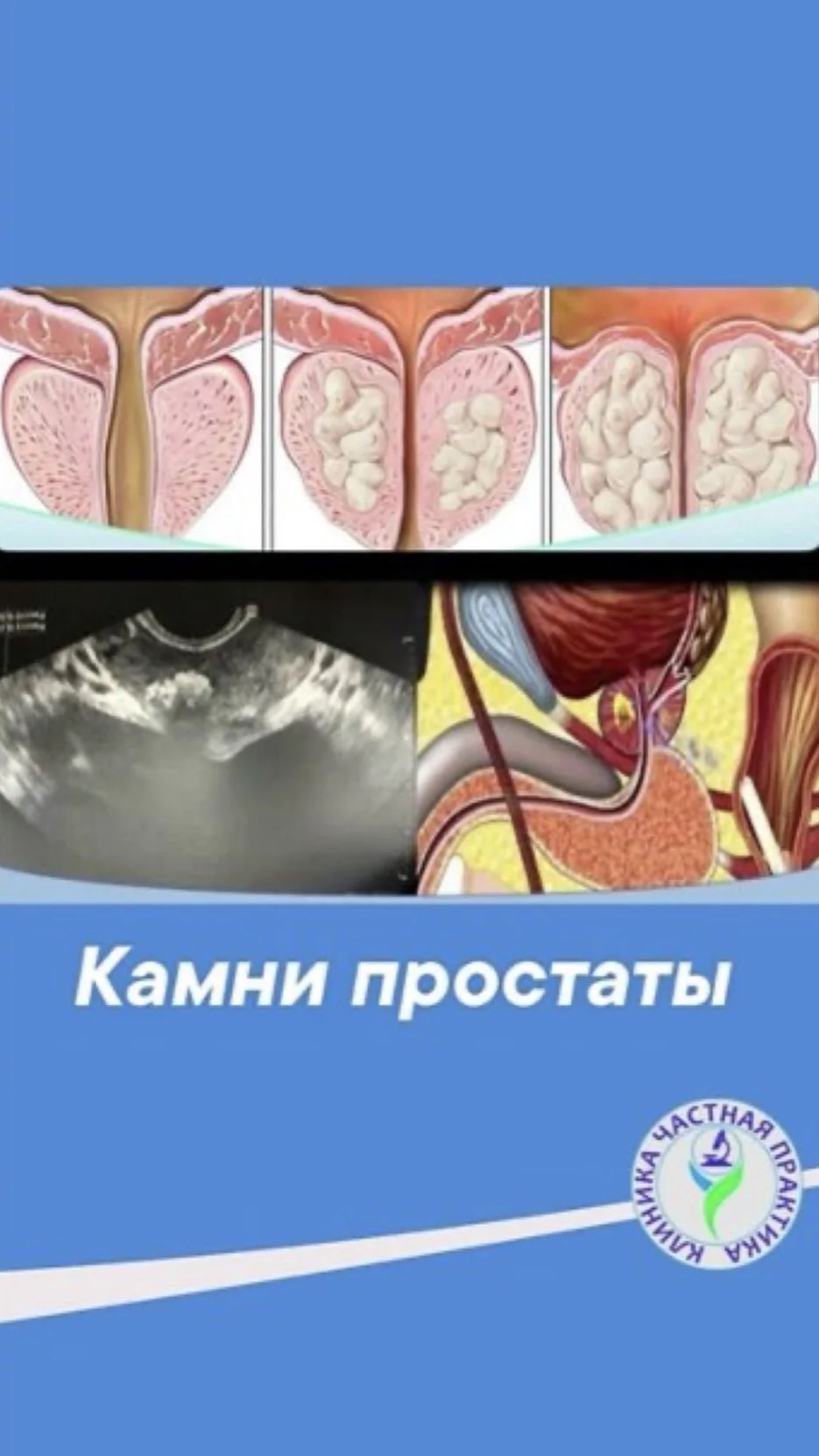 Камни простаты