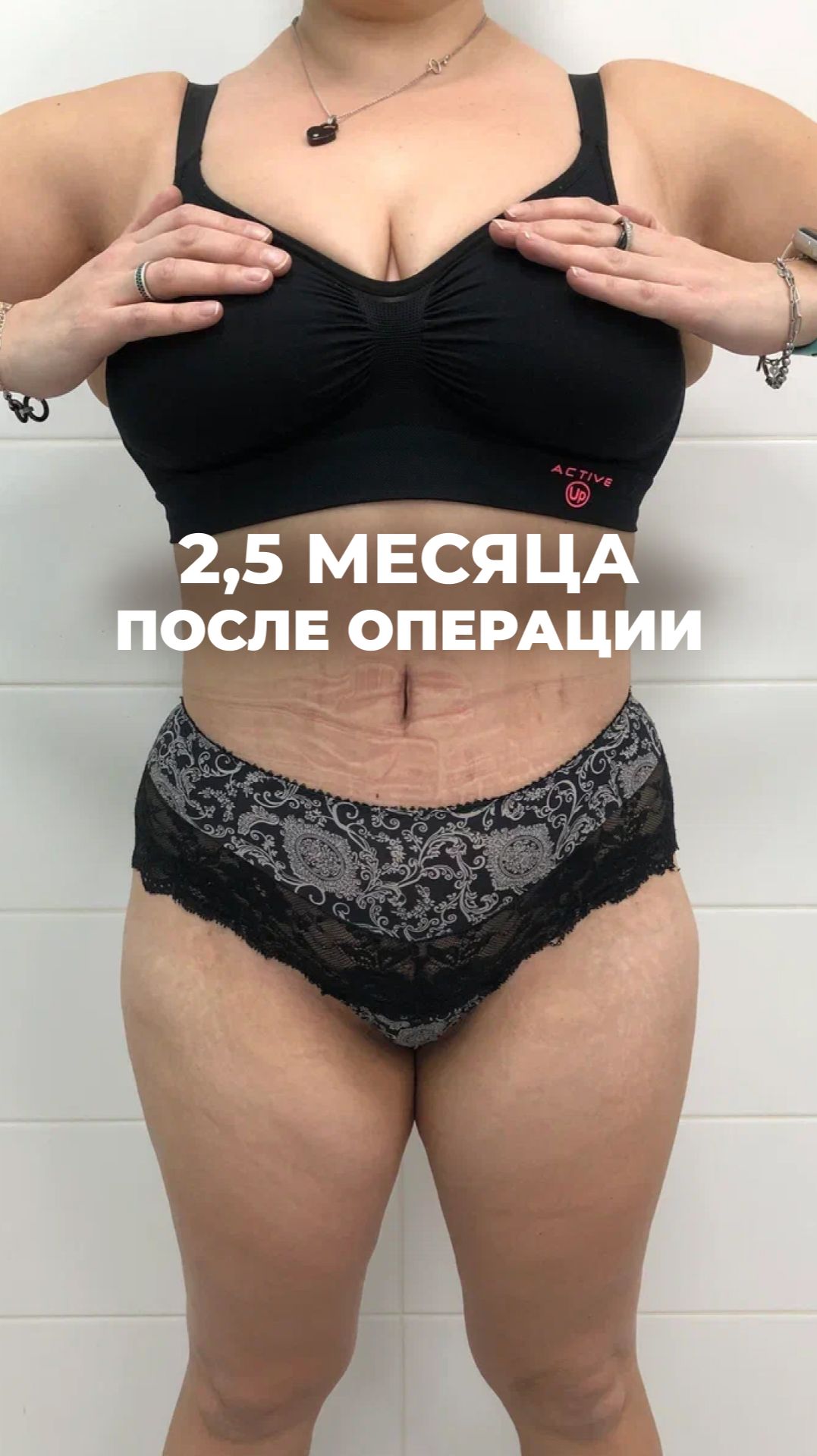 Круговая липосакция и абдоминопластика: до и после