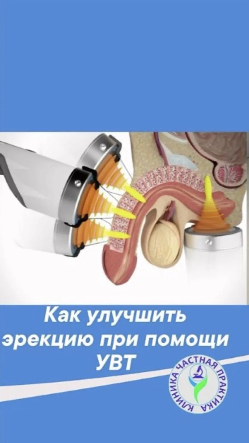 Как улучшить эрекцию при помощи ударно-волновой терапии
