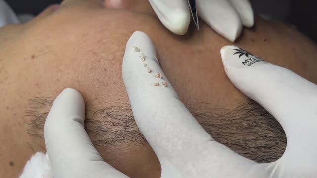 Чистим кожу от угрей и улучшаем текстуру.