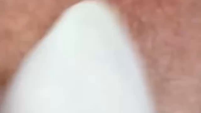 #264 Чистка лица от угрей и акне. Выдавливание прыщей. Удаление черных точек и комедонов