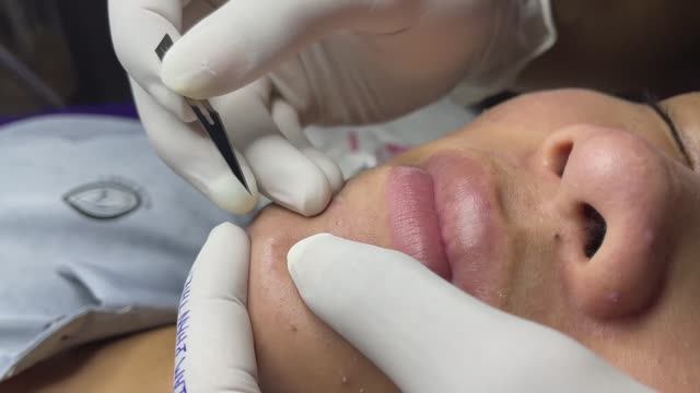 Asmr. Механическое очищение от открытых комедонов.