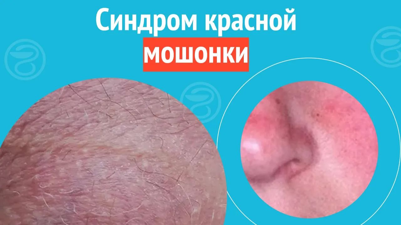 😡 Синдром красной мошонки. Клинический случай №1299