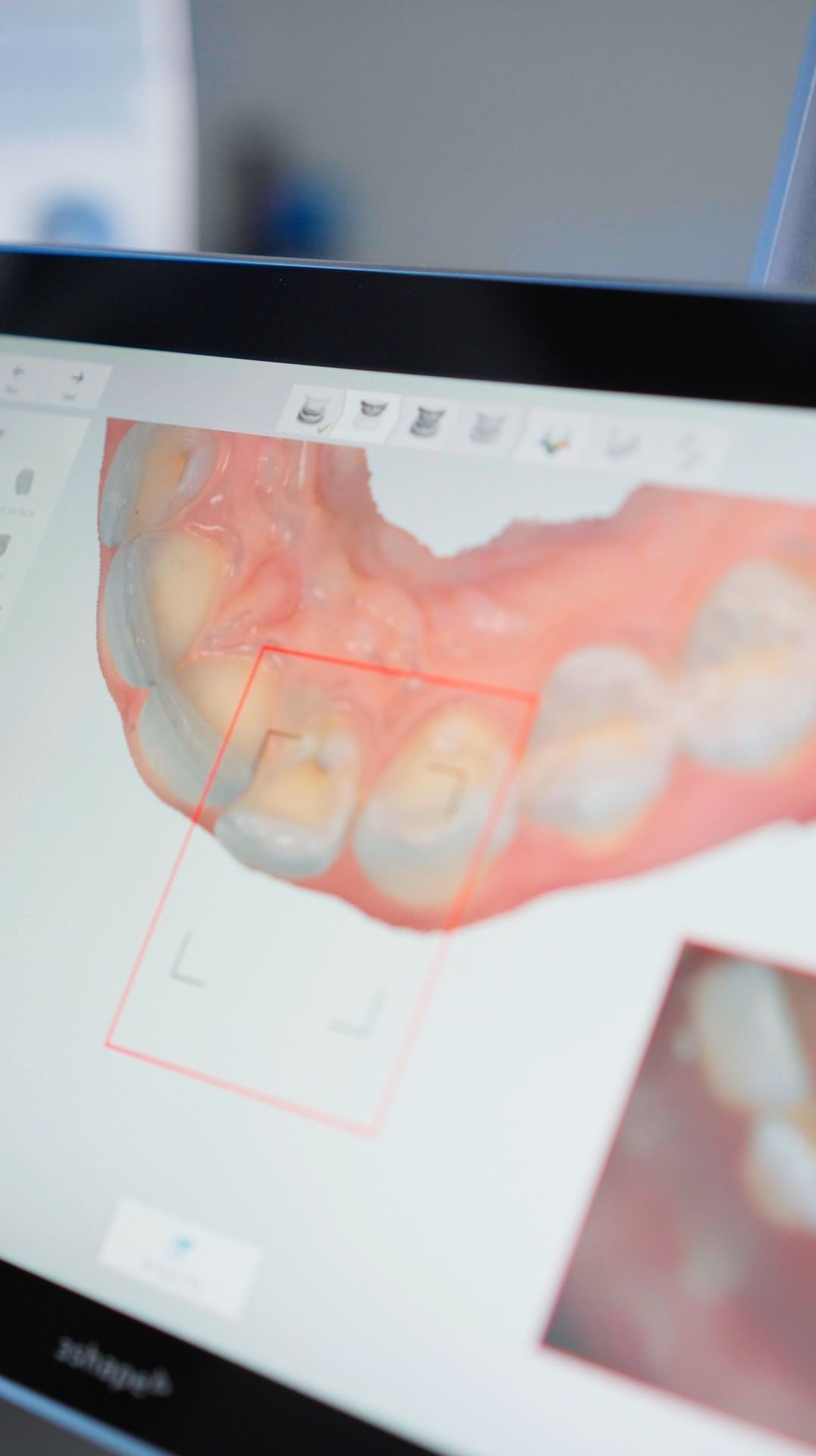 Почему стираются зубы раньше времени?